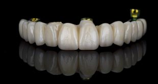cosmetic dental prosthesis